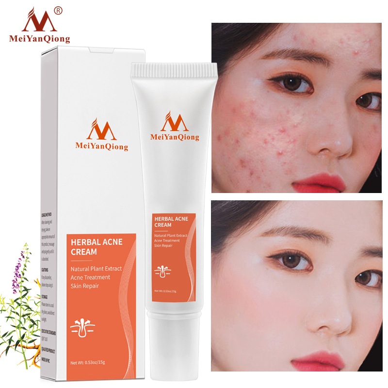 【CW】 Effective Acne Removal Herbal Anti acne Repair Fade Spots Oil Control Whitening Moisturizing Face Gel 15g