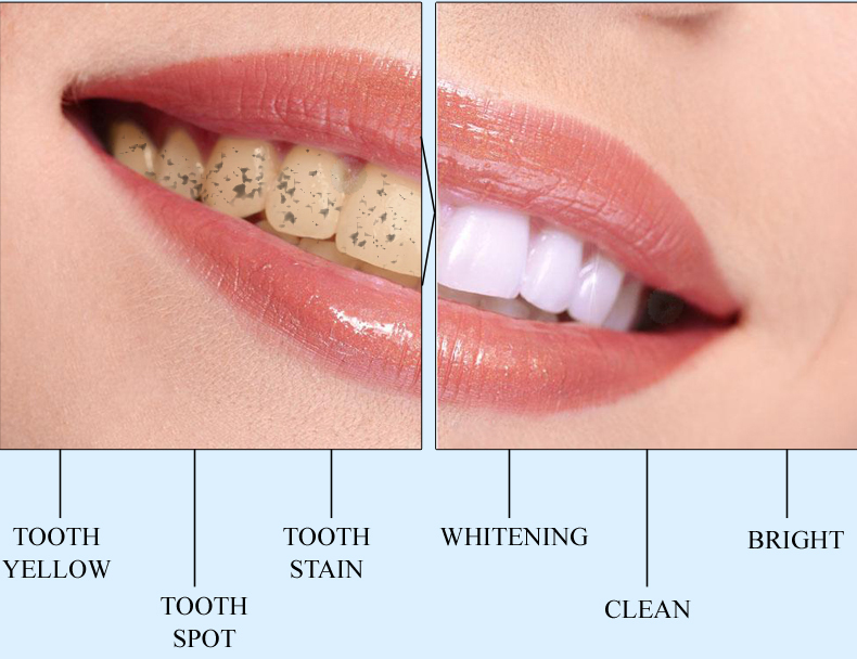 bút tẩy trắng răng khử mùi hôi miệng làm sạch răng tẩy vết ố răng teeth 3