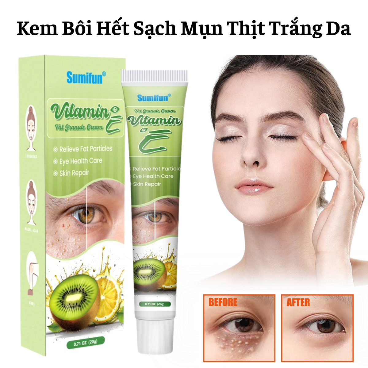 Kem Bôi Hết Sạch Mụn Thịt Quanh Mắt Và Toàn Bộ Cơ Thể Bổ Sung Vitamin E Làm Trắng Sáng Da