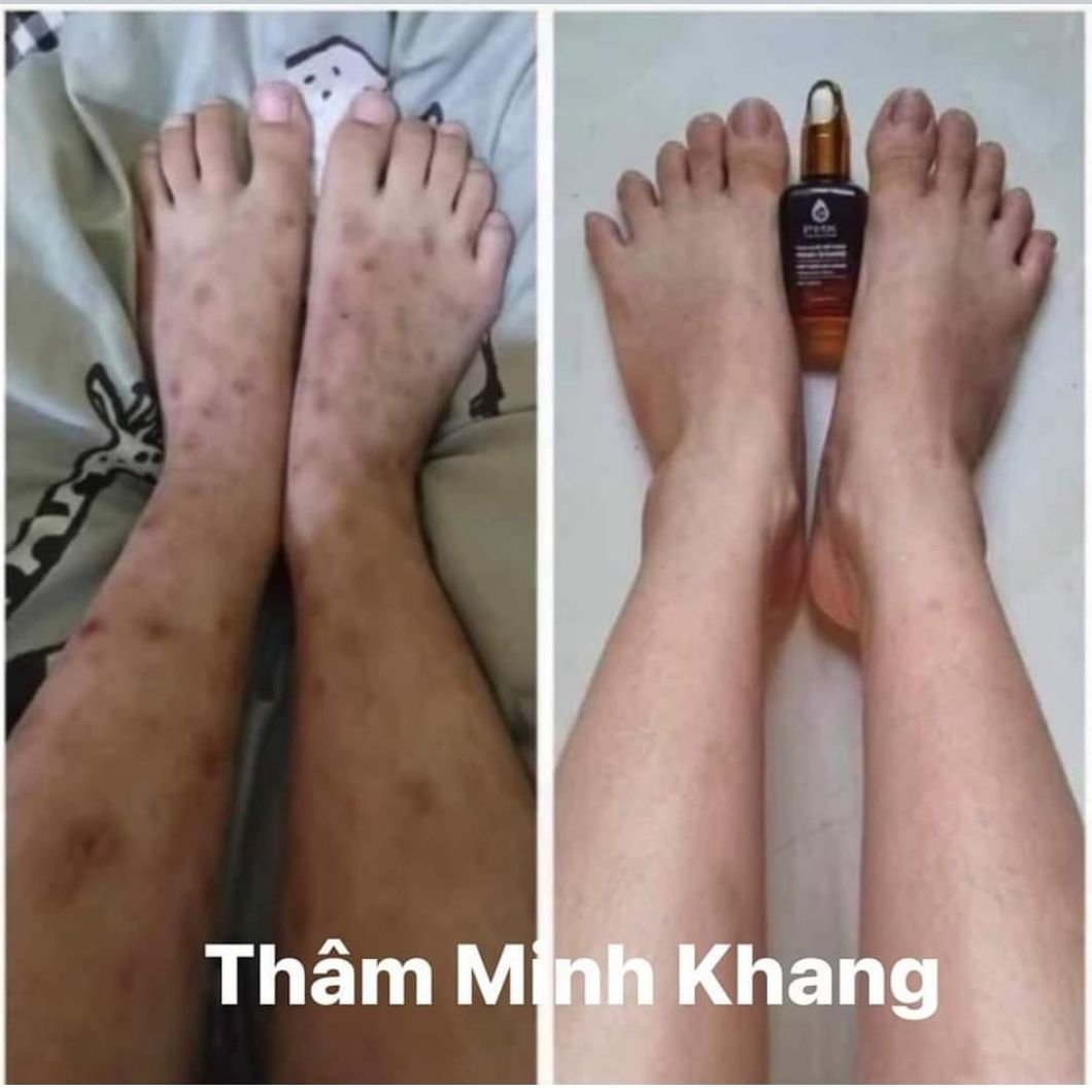 Serum mờ thâm đa năng phúc minh khang-mờ mọi vết thâm -dùng cho bé và mọi lứa tuổi