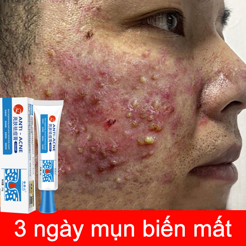 Kem dưỡng da MỤN trắng da CỰC TỐT Kem Mụn Giảm Mụn Loại Bỏ Thâm Mụn Làm Mờ Sẹ,Kem loại bỏ mụn nhanh chóng loại bỏ mụn bọc, kem xóa mụn, phục hồi vết tích mụn và chống viêm mụn