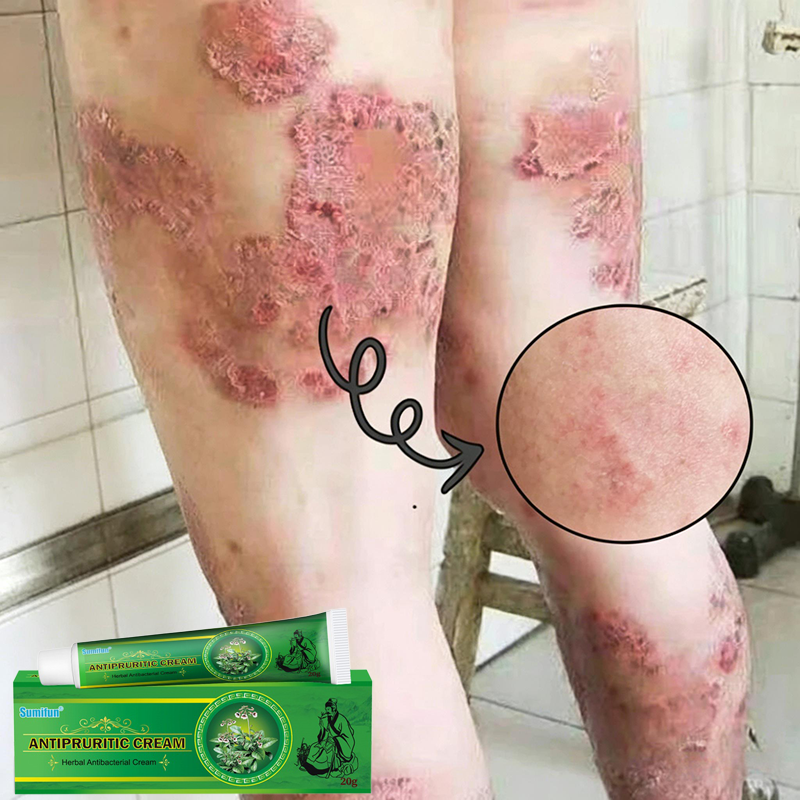 Kem loại bỏ vẩy nến nấm da hắc lào á sừng viêm da ngứa tay chân da đầu mông nấm Giảm ngứa Psoriasis oint 20g