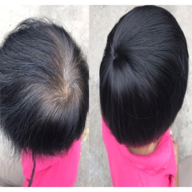 Tóc giả che hói, che bạc đỉnh đầu 15cm