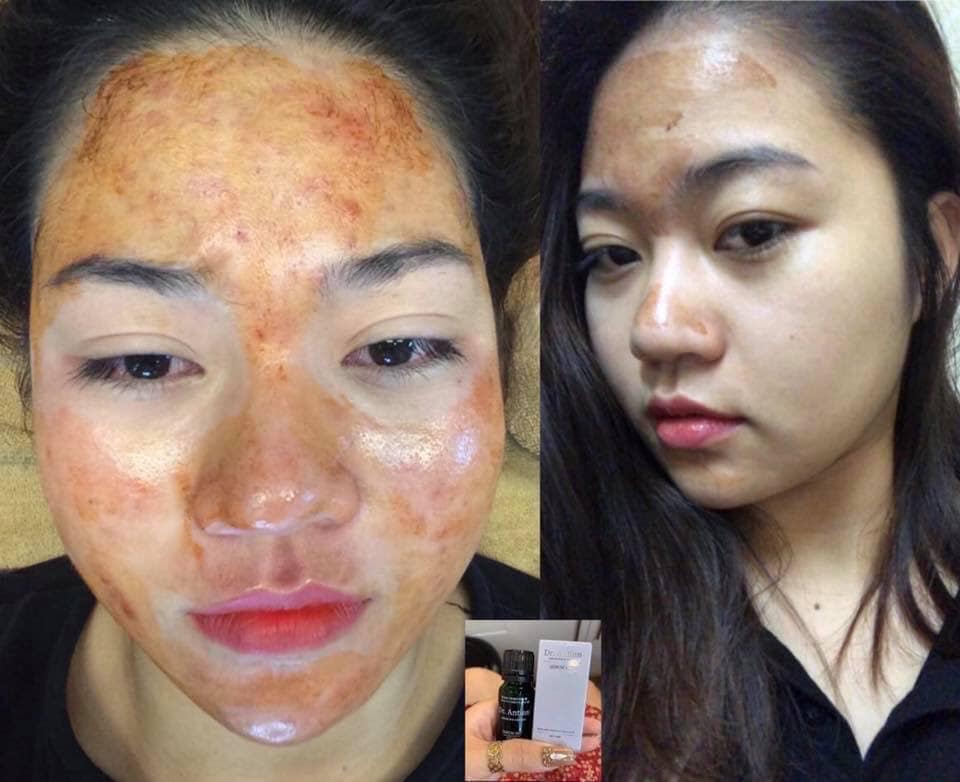 [CHÍNH HÃNG] Kháng sinh tươi Kim Thiên Hoa - HATHOR BEAUTY GROUP