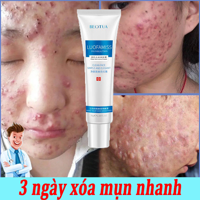 Kem mụn Gel giảm mụn giảm thâm Dòng kem ngăn ngừa mụn thâm sẹo rỗ trừ mụn hoàn toàn kháng viêm diệt khuẩn làm sáng da công giúp giảm mụn & phục hồi da 30g