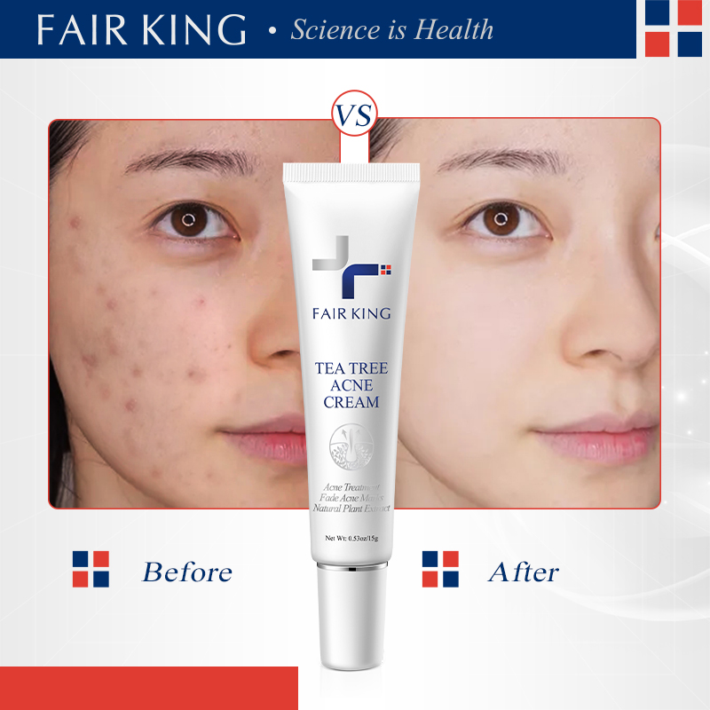 FAIR KING Loại bỏ Kem chống mụn làm trắng da mặt Làm sạch sâu Vết sẹo mụn thu nhỏ lỗ chân lông Kem chăm sóc da mặt Sửa mụn đầu đen