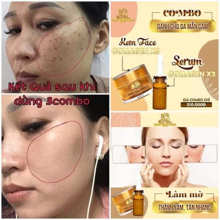 Combo Kem Face Collagen X3 đông anh và serum collagen X3