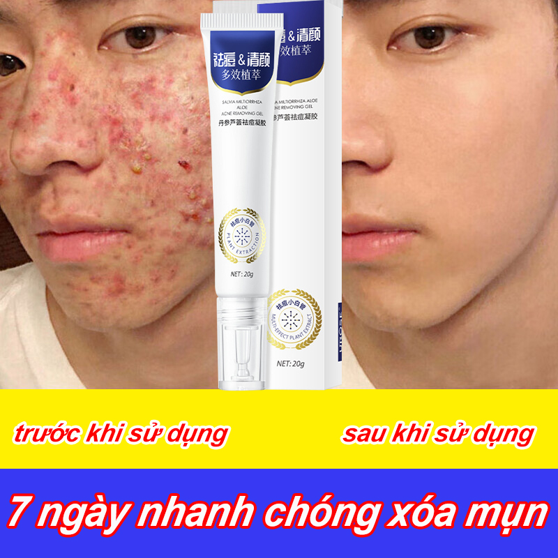 Kem chấm mụn tận gốc, Kem chấm mụn cấp tốc 20g loại bỏ các loại mụn, mụn ẩn, mụn đầu đen, mụn ở tuổi dậy thì, loại bỏ mụn bọc cho da dầu, loại bỏ mụn cho da nhạy cảm, ​loại bỏ mụn thâm, sử dụng cho nam và nữ