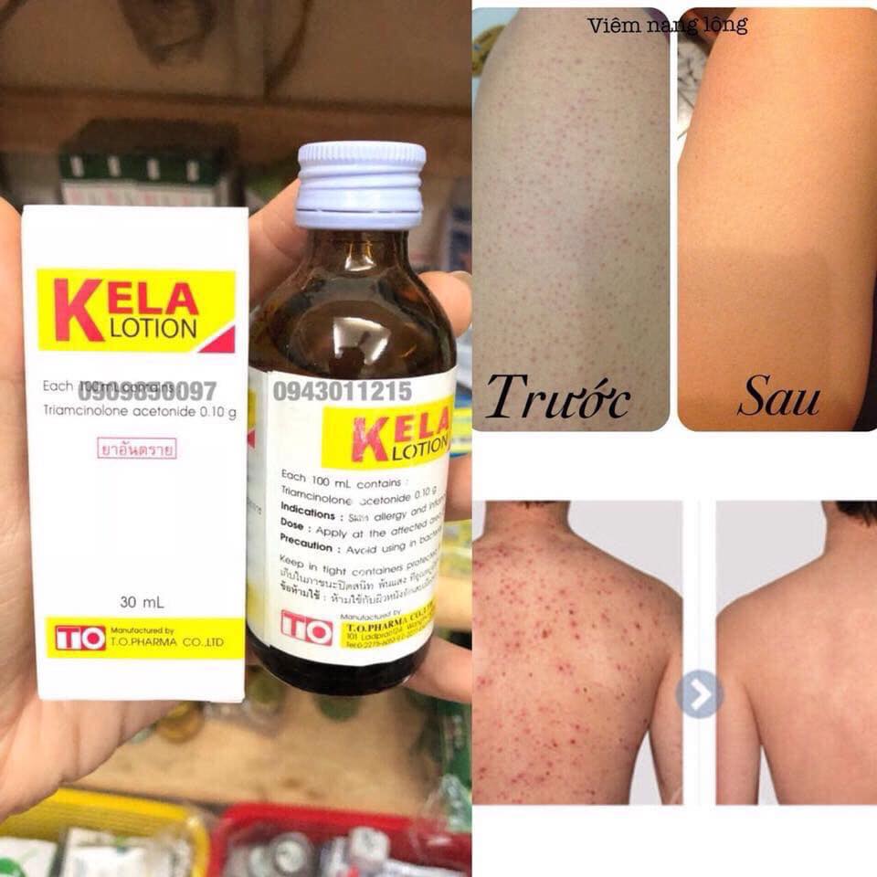 Bôi viêm lỗ chân lông kela lotion thái lan
