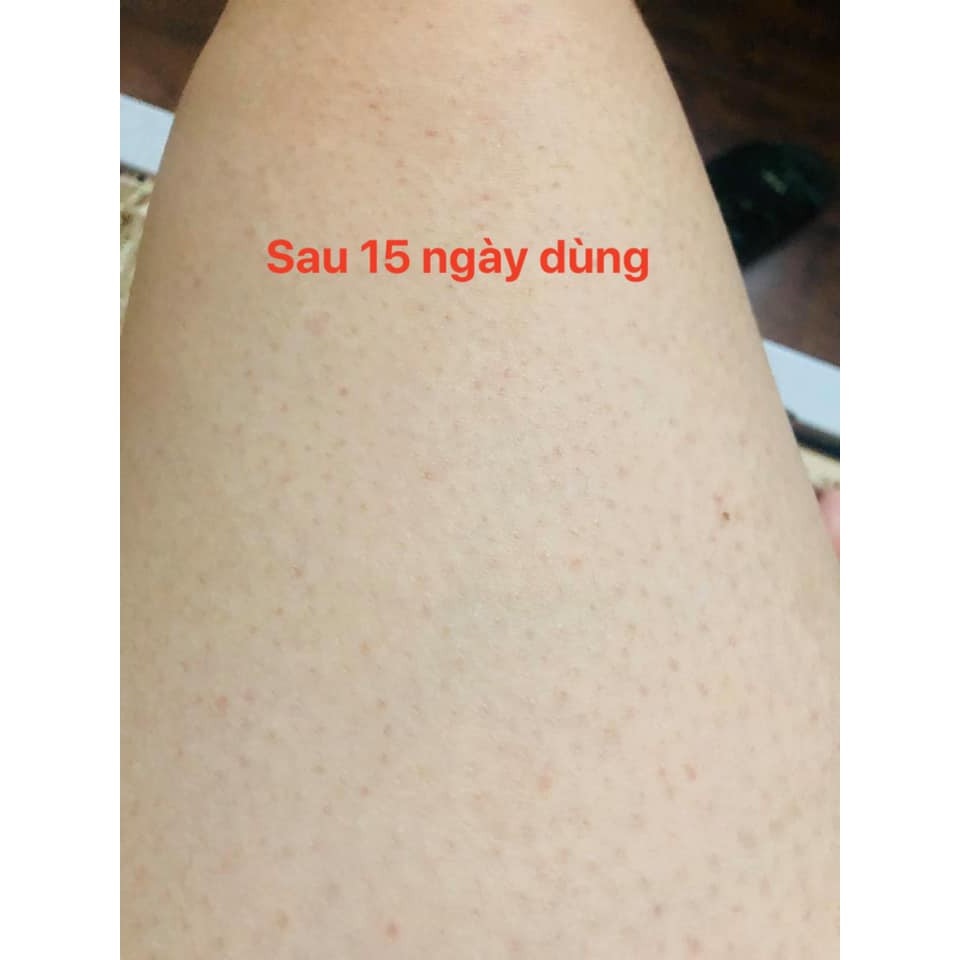 Xà phòng cục loại bỏ viêm nang lông - xà bông handmade 130gr