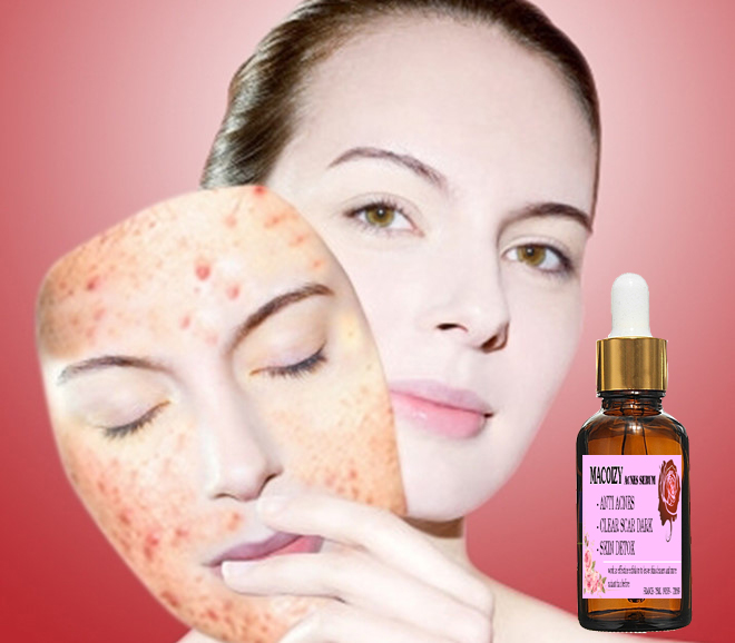 Serum Giảm Mụn Mờ Thâm Macoizy Của Pháp