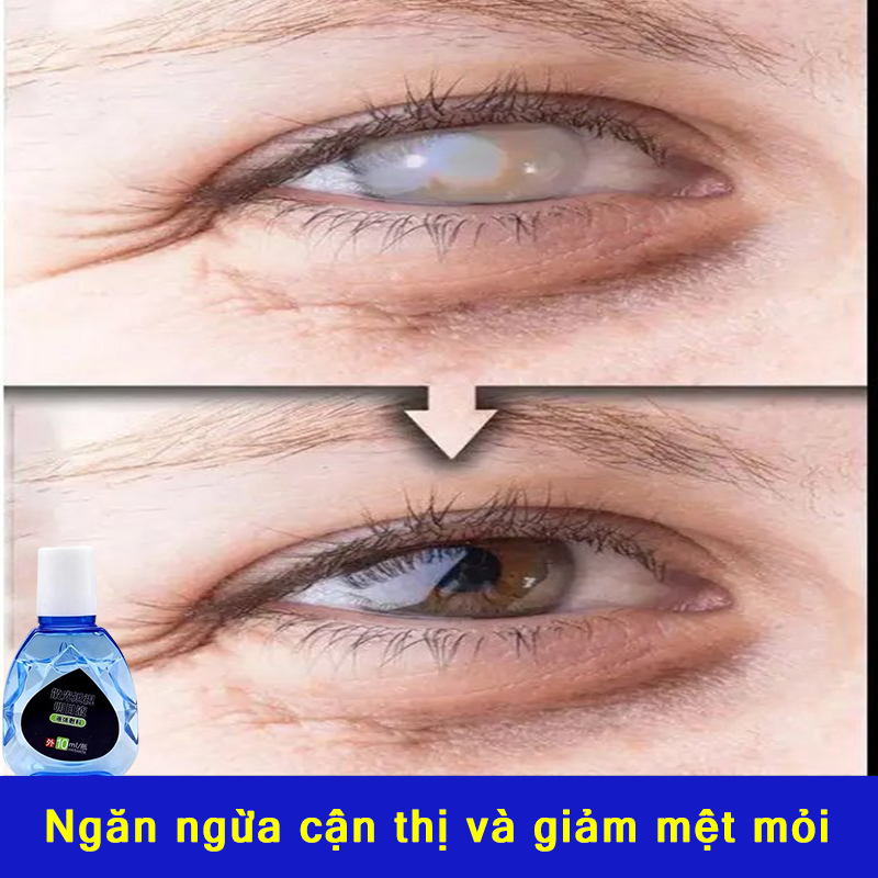 thuốc nhỏ mắt cận giảm cận đục thủy đau mắt đỏ khô mắt mỏi Thiện Tình Trạng Về Mắt Giảm khô mắt Giúp Làm Mắt Sáng Khỏe Nhìn Rõ Hơn