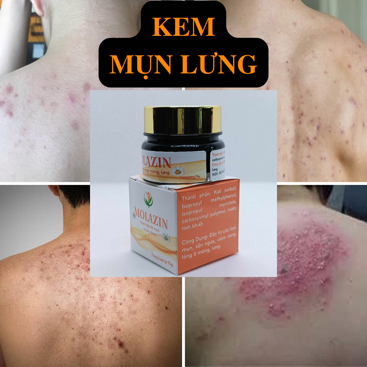 Kem mụn lưng molazin hiệu quả cho bôi mụn li ti chấm mụn nhọt viêm nang lông mụn phát ban