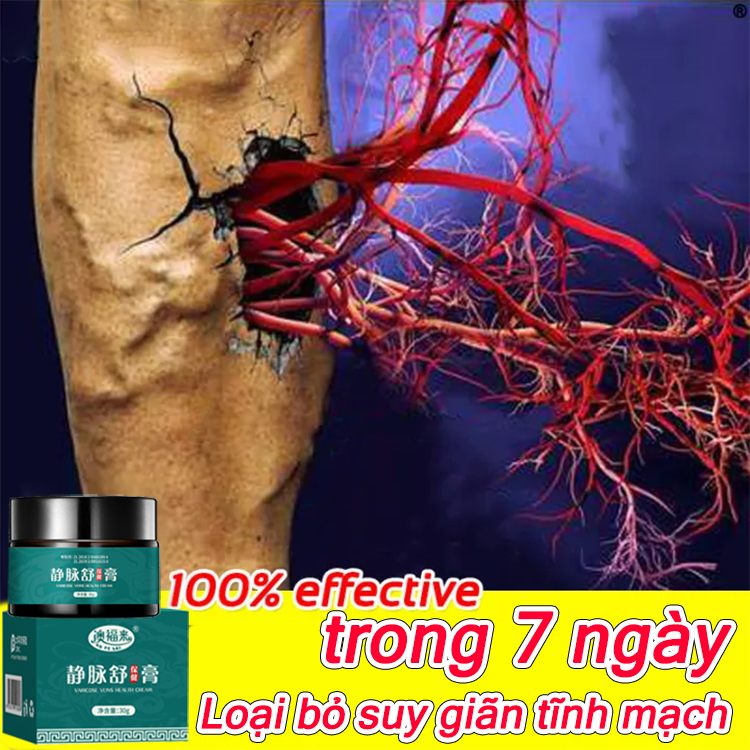 Kem giãn tĩnh mạch, Kem loại bỏ suy giãn tĩnh mạch chân 30g phục hồi hiệu quả các mạch máu bị sưng ở tay và chân, phục hồi suy giãn tĩnh mạch chân