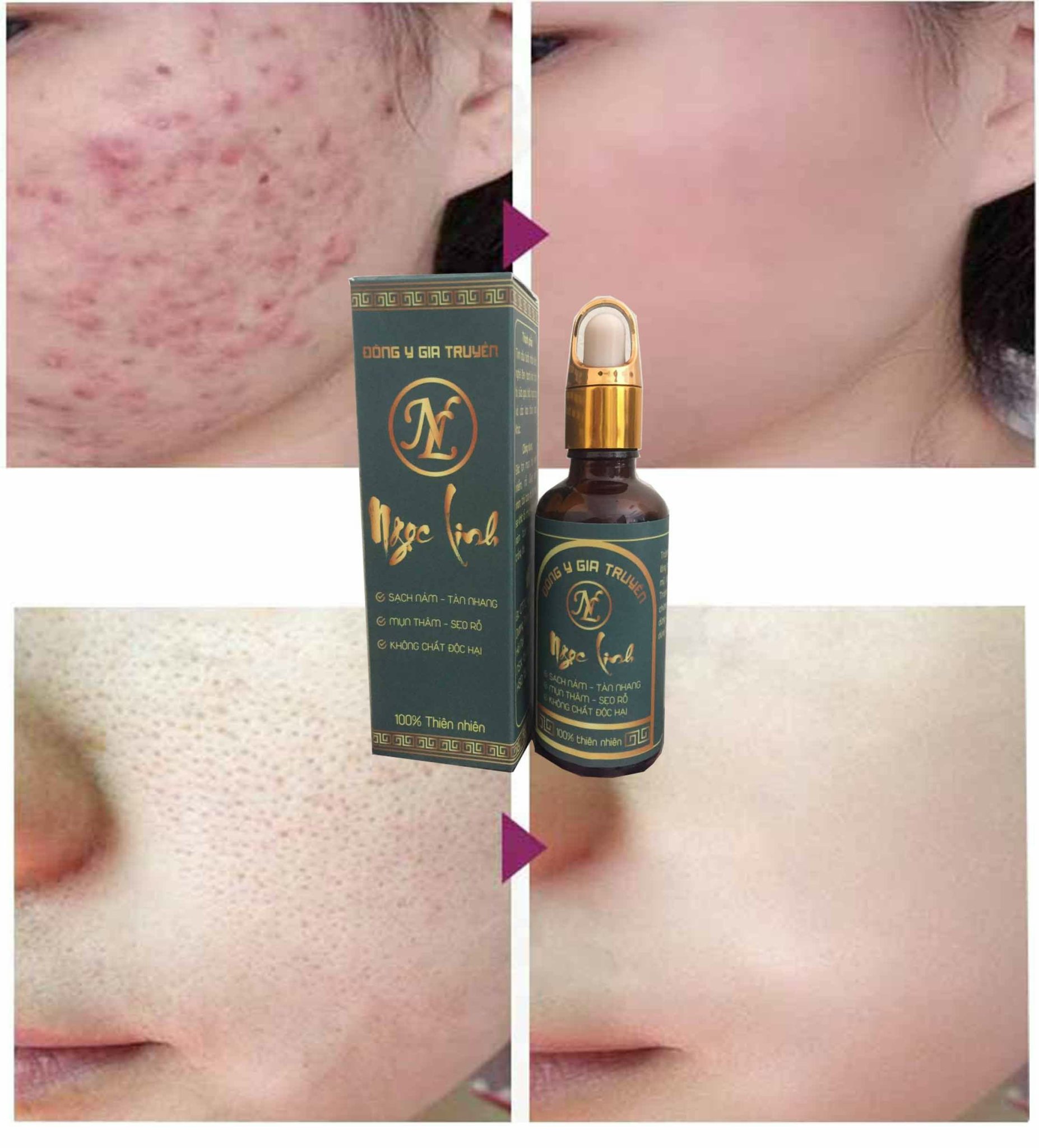 Tinh chất tái tạo da đa tầng hết mụn, nám, tàn nhang làm đầy sẹo rỗ và se khít lỗ chân lông 50ml như kem hàn quốc, nhạt bản MUA 2 LỌ TẶNG 1 LỌ TINH CHẤT VÀNG 24K