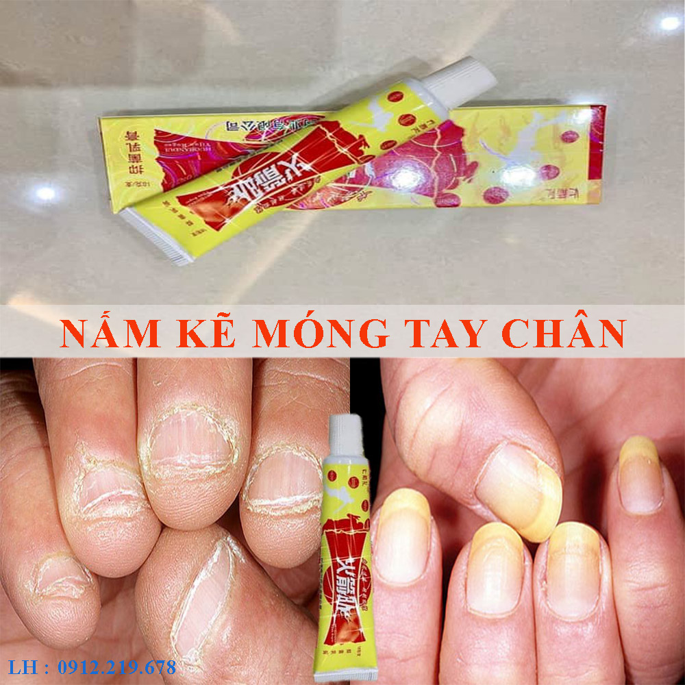 KEM BÔI NẤM KẼ MÓNG TAY - MÓNG CHÂN - NẤM DA TQ