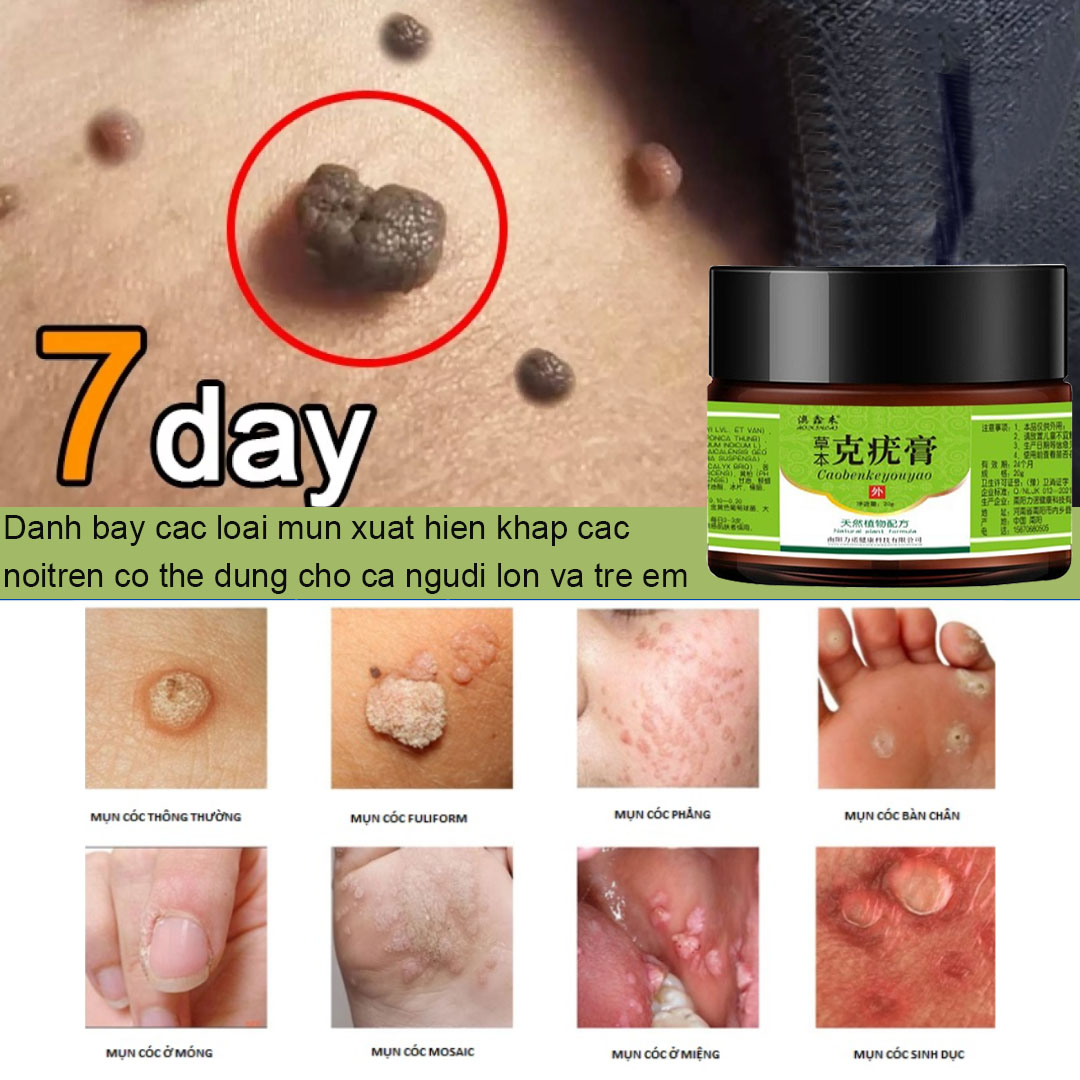 Loại bỏ mụn cóc phẳng thuốc mỡ mụn cơm mụn cóc hiệu ứng đặc biệt thuốc ngô thuốc mỡ loại bỏ mụn cóc thông thường mụn thịt nhỏ hạt thịt đặc biệt
