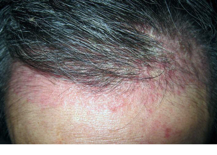 Thảo Dược Hết Sạch bong tróc, ngứa, lột vảy trắng từng mảng da đầu (Đông Y Cổ Truyền)