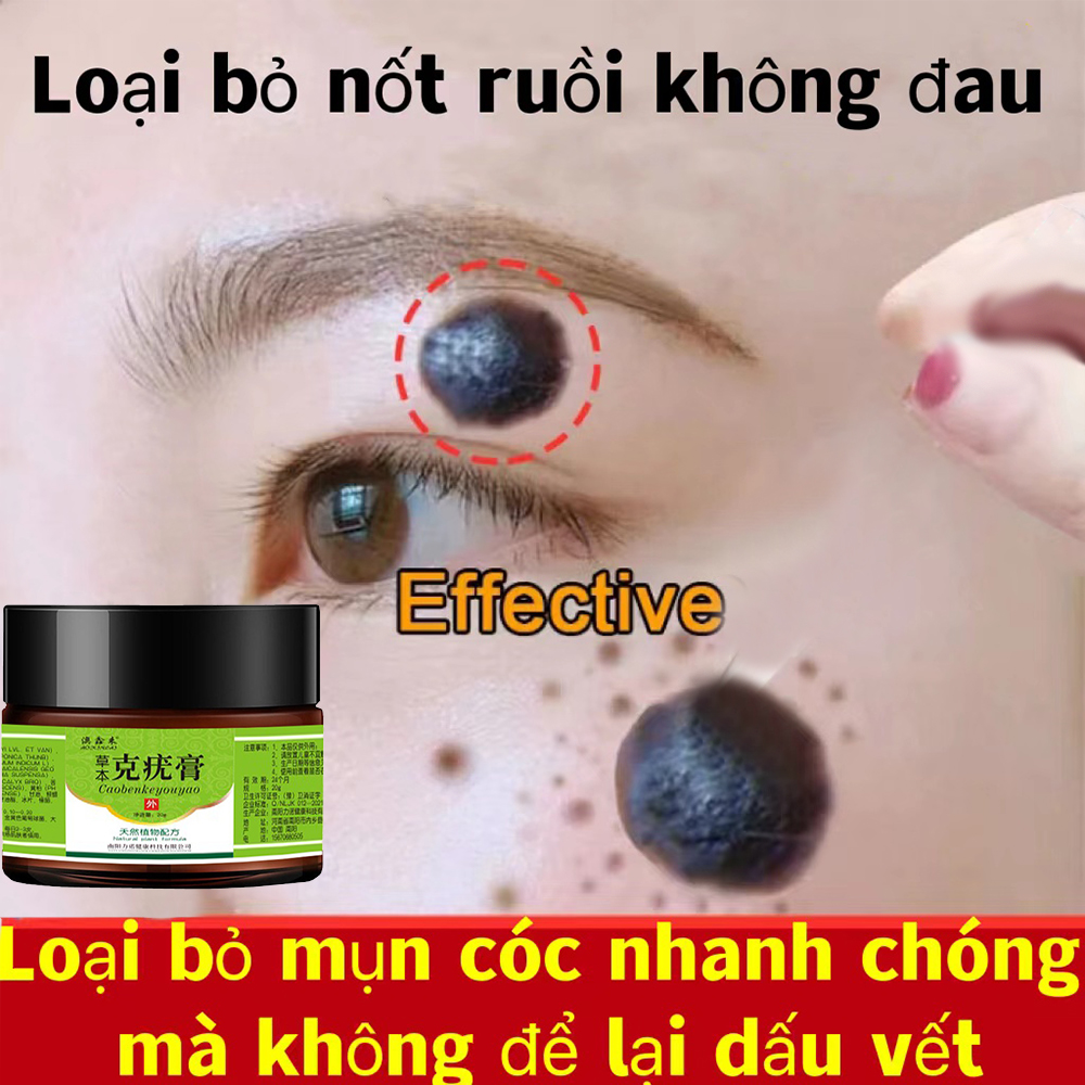 kem xóa mụn cócTẩy xoá nốt ruồi tàn nhang mụn cóc Loại bỏ mụn ruồi trâumụn thịt mắt cá