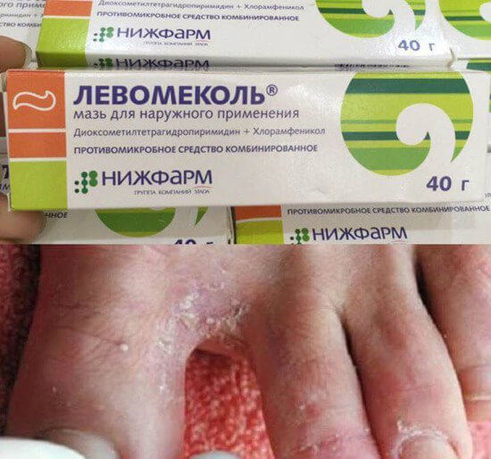 Kem nấm, ngứa, á sừng, nước ăn chân tay levomekol nga 40gr