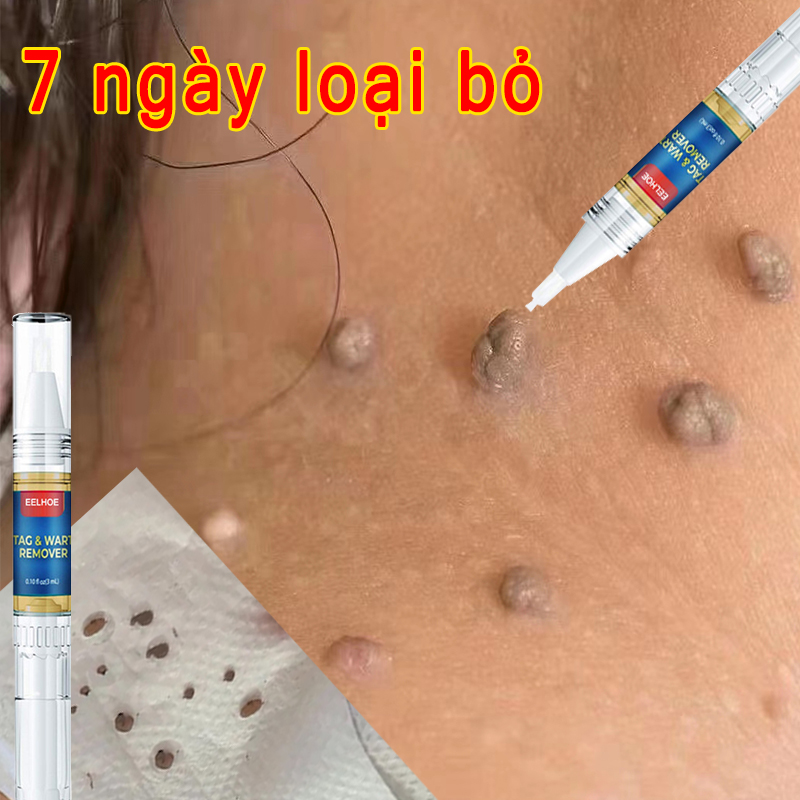 Tẩy nốt ruồi chấm nốt ruồi tẩy nốt mụn cóc loại bỏ dứt khoát mụn cóc, mụn cơm, da chai sần nốt ruồi loại bỏ Mụn cơm Mụn ruồi đen Mụn ruồi lồi