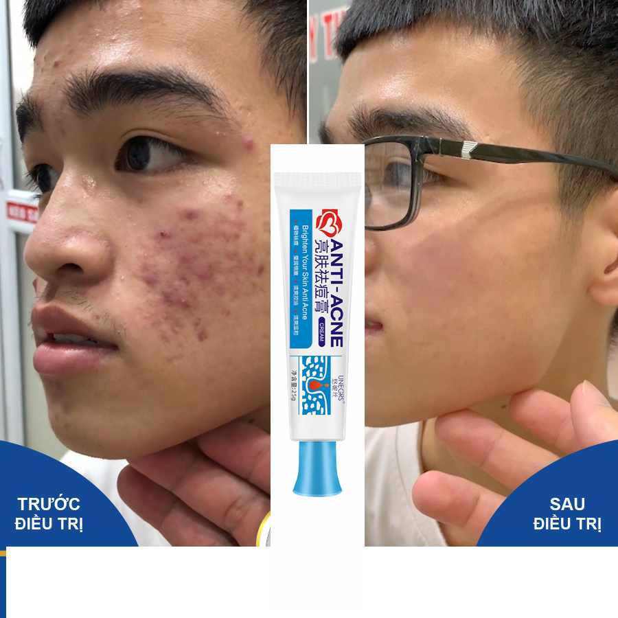 Tinh chất gel xóa mụn Gel chống mụn Kem xóa vết thâm mụn,kem giảm mụn làm mờ vết thâm mụn, loại bỏ mụn trứng cá, mụn bọc Kim soát dầu và mụn 25g