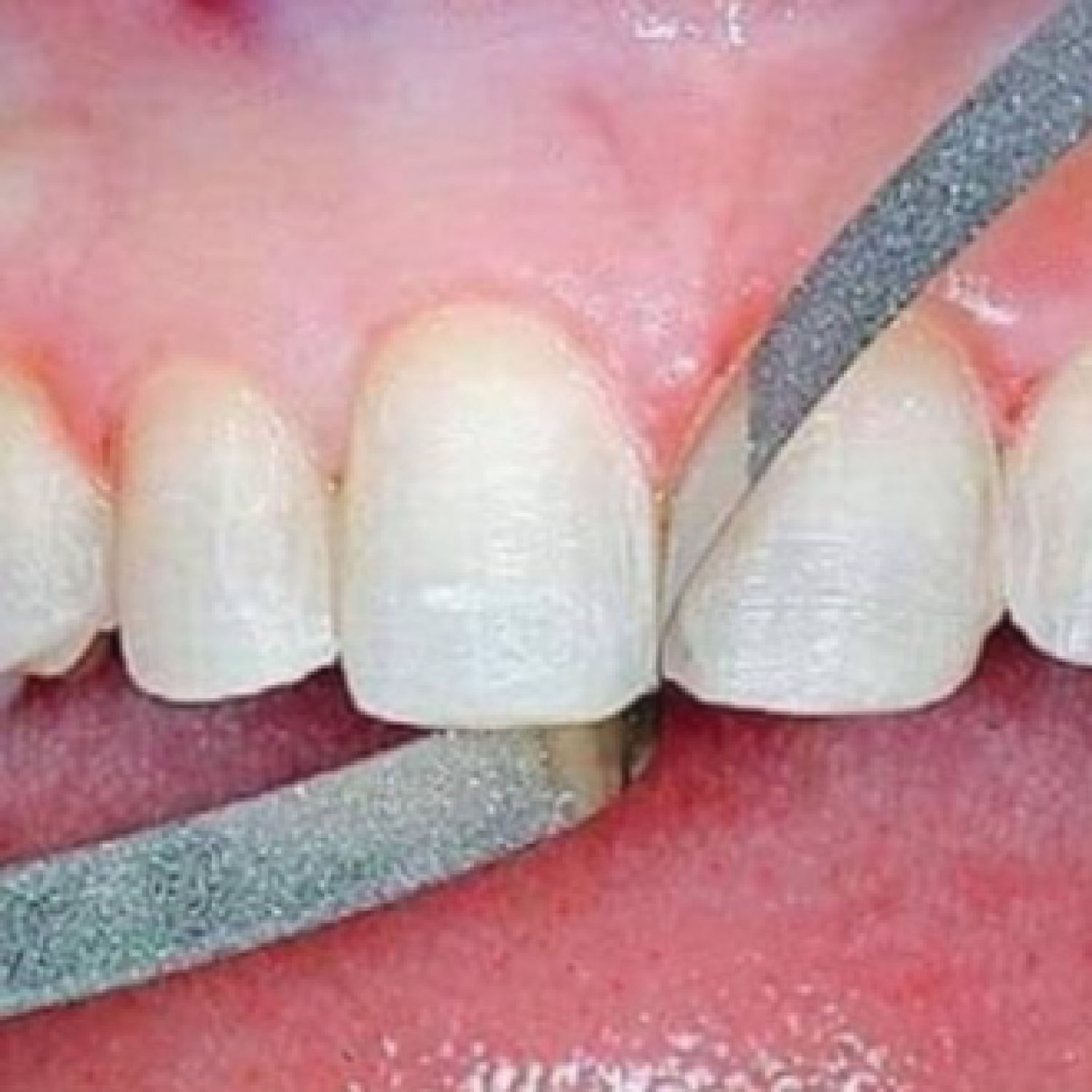 Lá mài kẽ răng,vật liệu nha khoa nhám kẽ răng