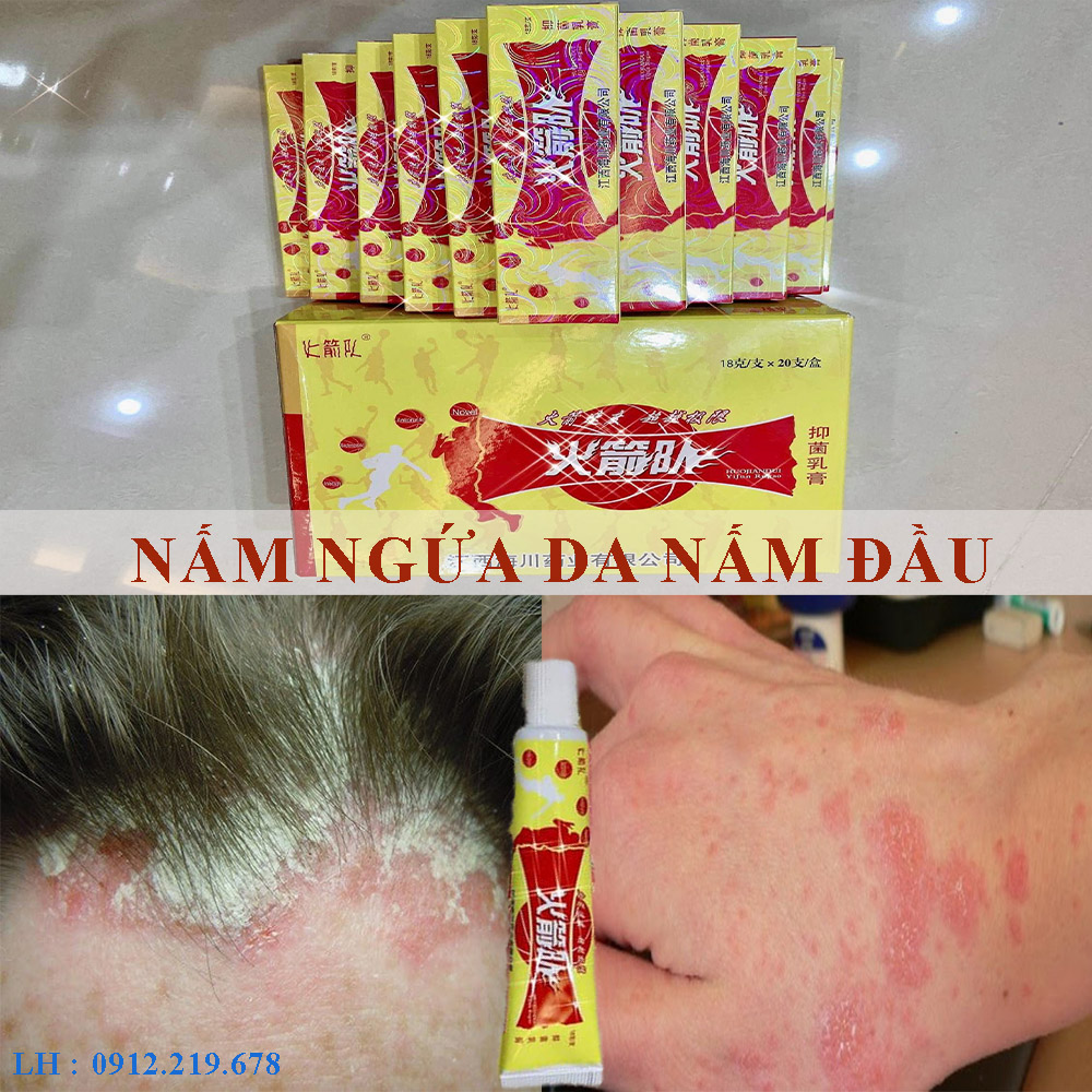 KEM BÔI NẤM NGỨA - NẤM DA ĐẦU NỘI ĐỊA TRUNG QUỐC