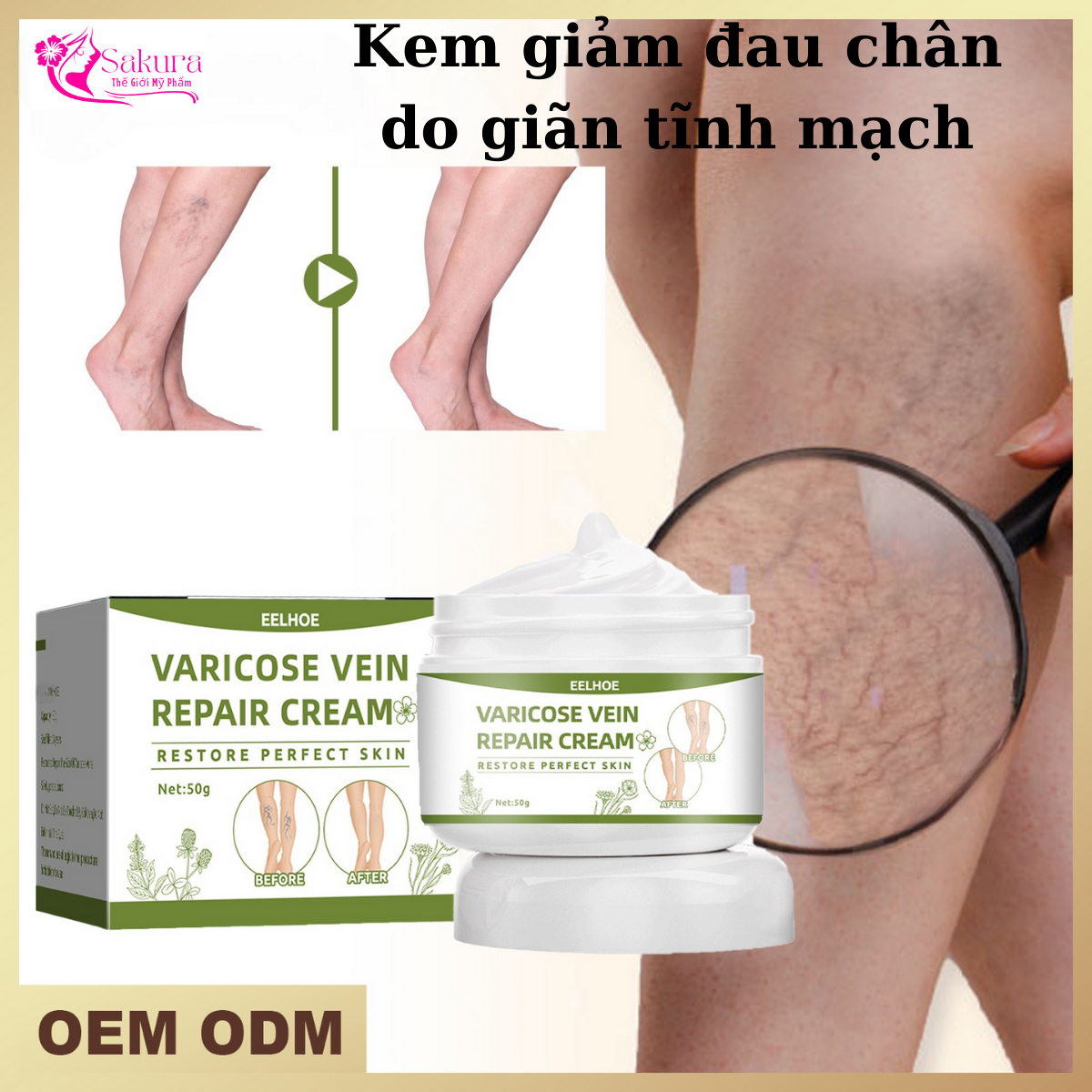 Kem bôi giảm suy giãn tĩnh mạch, giảm đau nhức suy giãn tĩnh mạch, hết đau tĩnh mạch nhẹ nhàng, hiệu quả