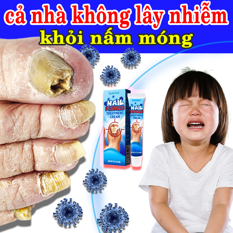 Thuốc trị nấm móng Kem trị nấm móng tay chân Điều trị các bệnh về móng Phục hồi móng Dày móng Dưỡng móng Hiệu quả nhanh chóng Thành phần an toàn 20g