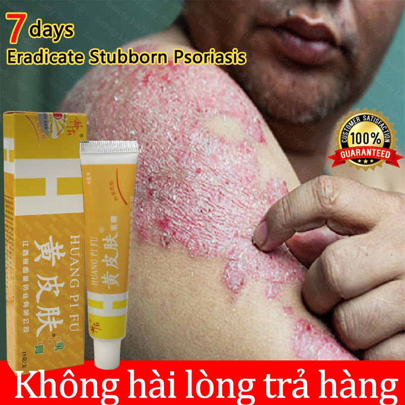Kem bôi nấm xanh,Kem bôi nấm ngứa, vảy nến tổ đỉa, hắc lào, viêm da cơ địa hàng nội địa Trung chính hãng, hắc lào, lang ben, nấm da