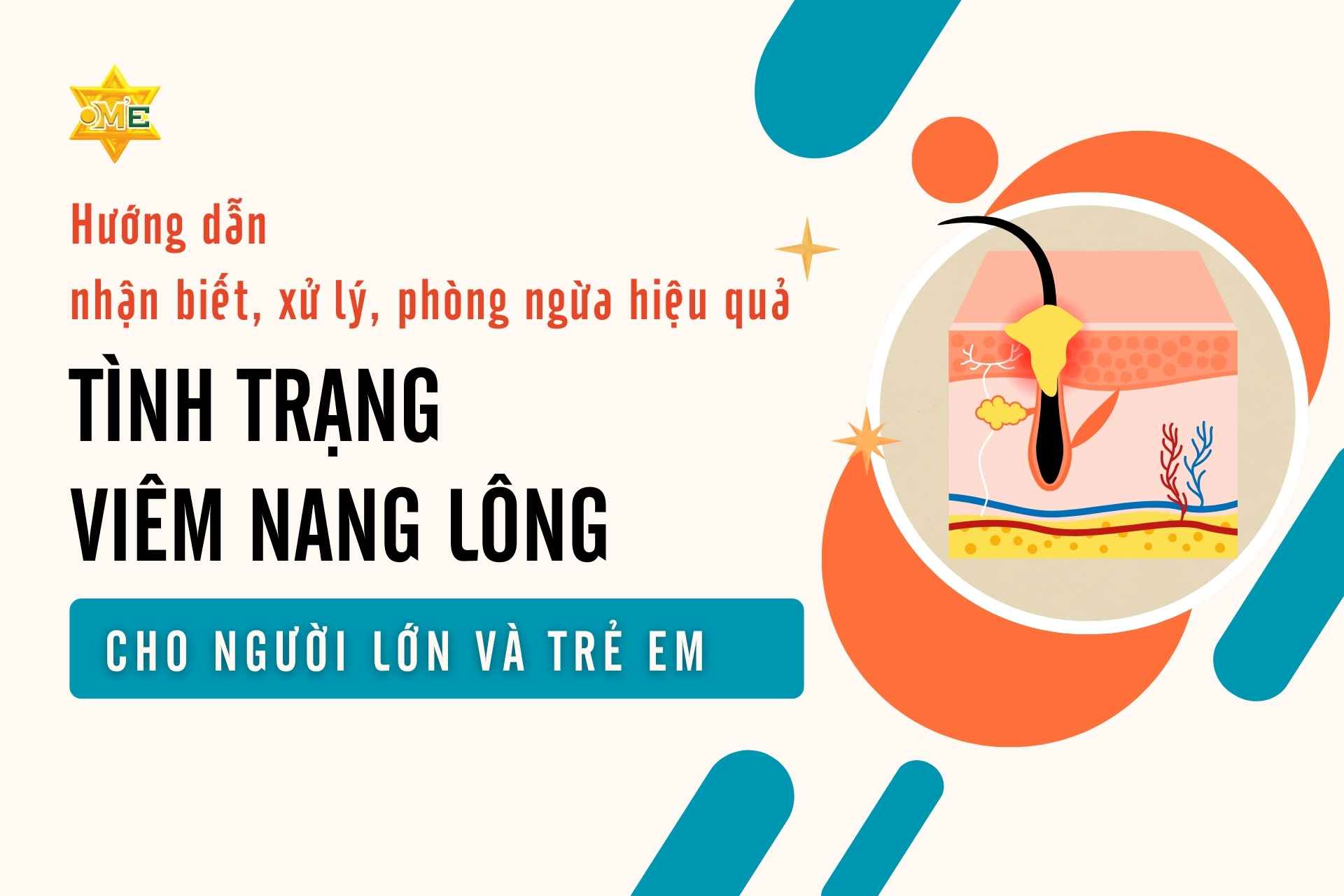 Khóa học Hướng dẫn nhận biết, xử lý, phòng ngừa hiệu quả tình trạng viêm nang lông cho người lớn và trẻ em - Khóa học Online - Trung tâm OM'E