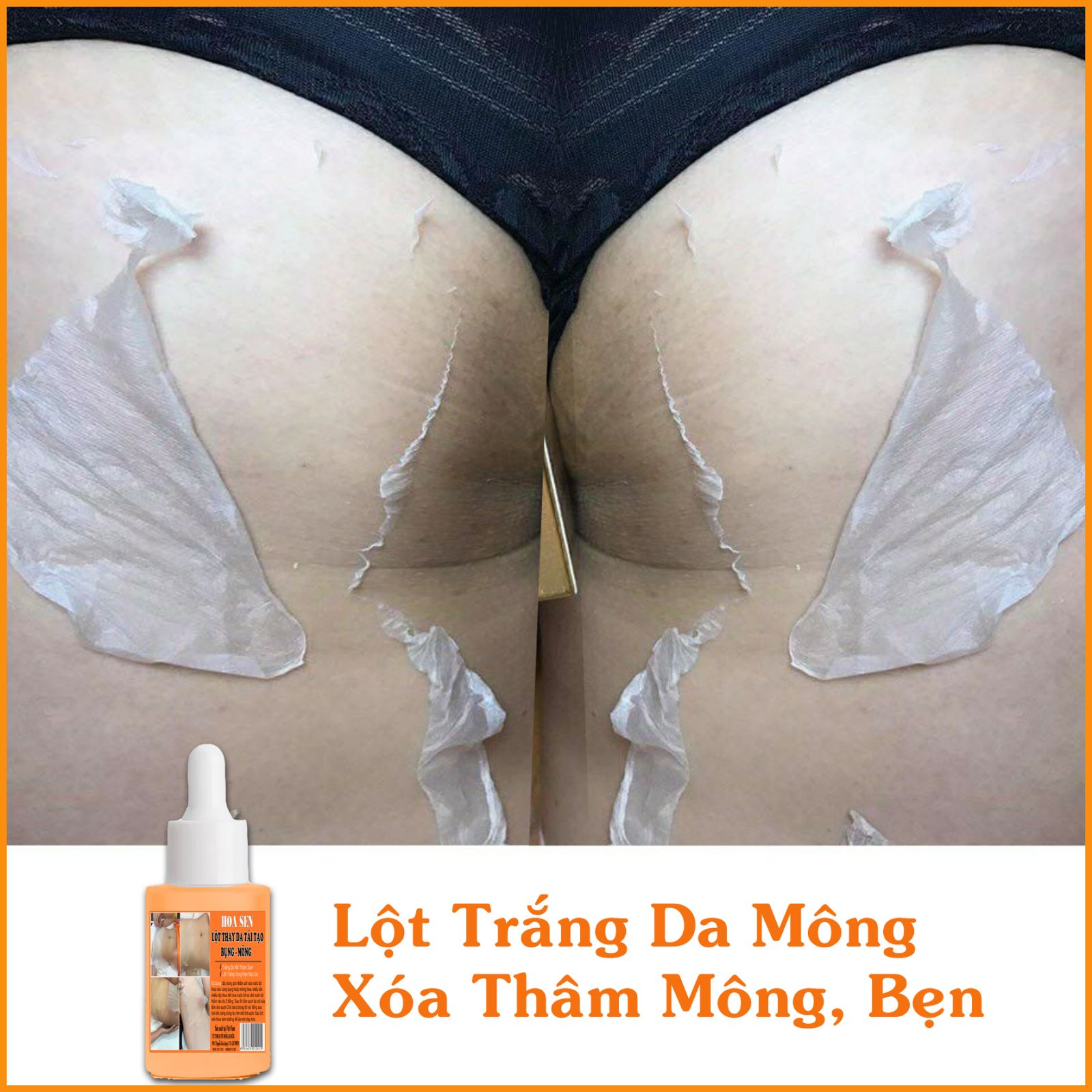 Lột trắng da bụng mông bẹn mờ rạn da thâm sạm
