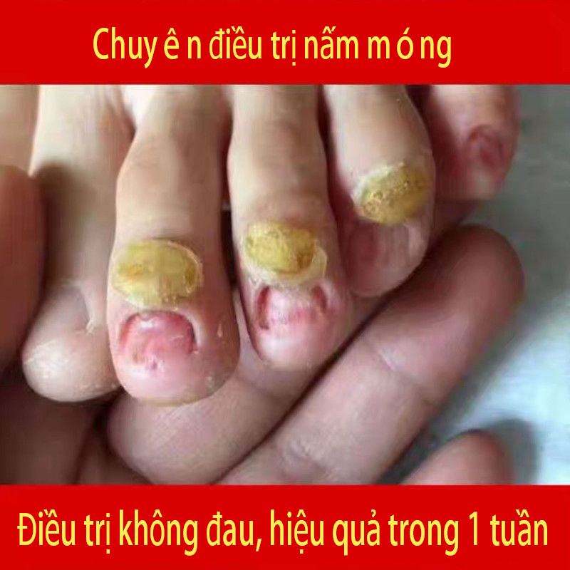 Bút Tinh Chất Phục Hồi Móng Serum Trị Nấm Móng Loại Bỏ Nấm Móng Paronychia Chống Nấm Nhiễm Trùng Móng Chân Nuôi Dưỡng Làm Sáng Móng Tay Chân Chăm Sóc Kháng Khuẩn 5Ml