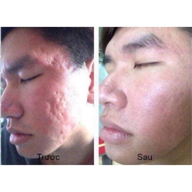 Peel da TCA 50% Đặc Trị Sẹo Rỗ, đánh bay Mụn, Hết thâm, nám, lỗ chân lông to, da dầu, rạn, sẹo lồi, Làm Hồng Ti, Hết Thâm Bẹn Nách, làm trắng mịn da