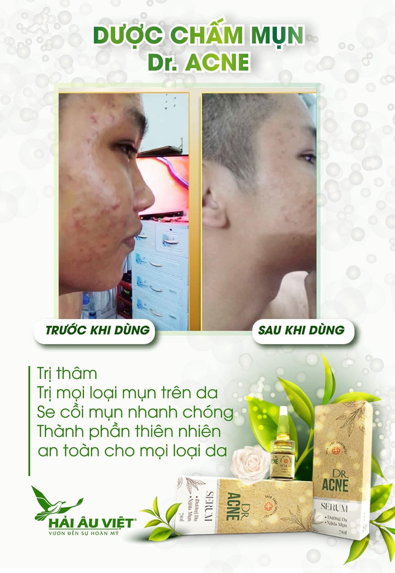 Chấm mụn 2 lớp xẹp mụn sau 4h