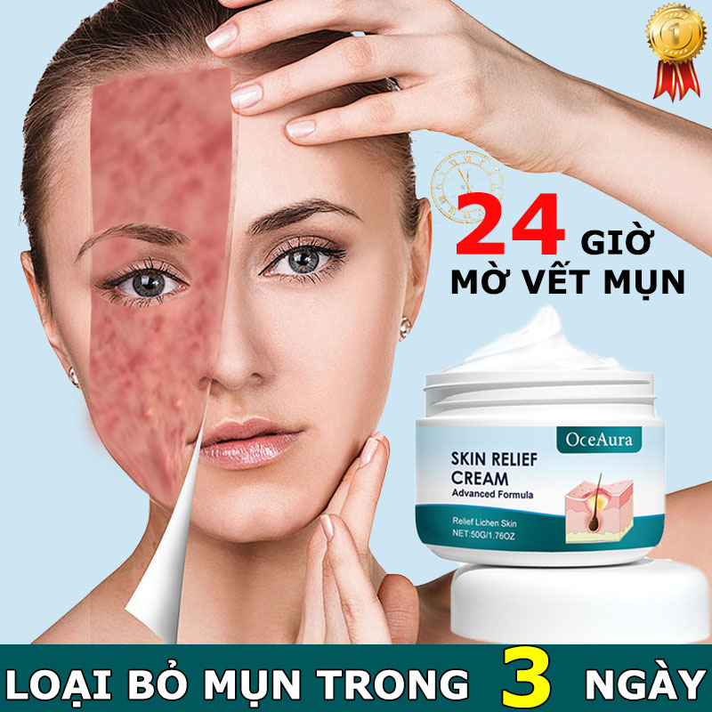 Kem chấm mụn hiệu quả hết mụn 24h Thích hợp cho mọi làn da đánh bay mụn bọc ,mụn ẩn ,mụn đầu đen,vết thâm nám do mụn để lại, phục hồi da trắng sáng mịn màng
