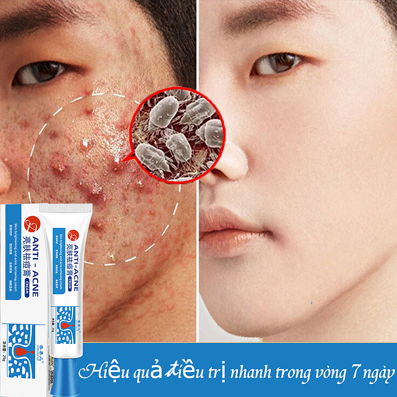 Gel chống mụn Serum Loại Bỏ Mụn Chuyên Biệt Gel xoá mụn nhanh chóngMụn ẩnkem ngăn ngừa mụn trứng cá hiệu quả nam nữ xoá mụn hiệu quả làm nhạt vết mụn giảm mụn trứng cá Kiểm Soát Dầu Phục Hồi Da Nhanh Chóng