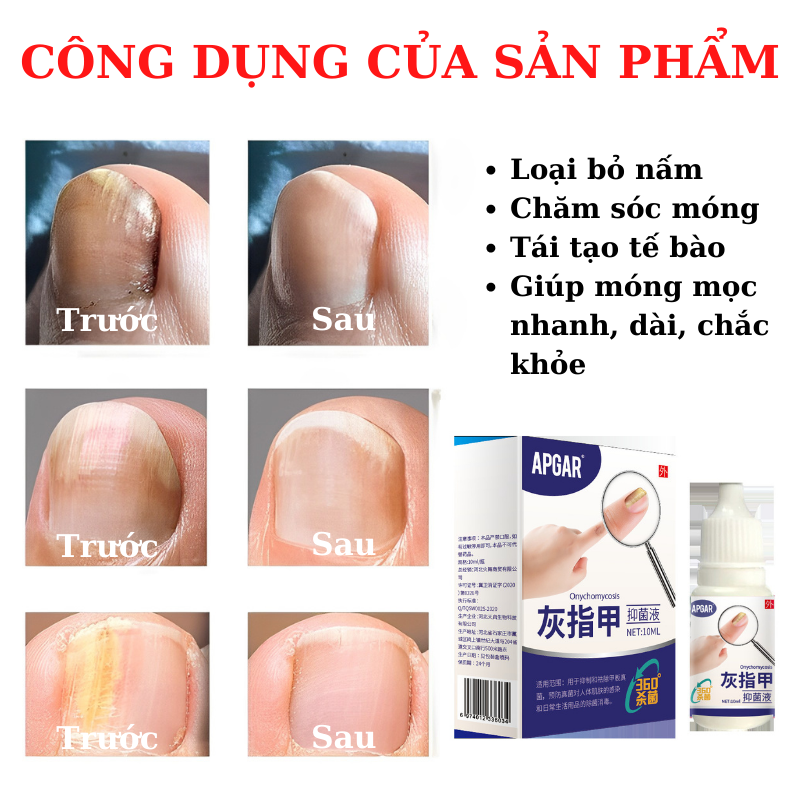 Dung dịch loại bỏ nấm móng tay APGAR 10ml , hết nấm móng, chăm sóc da tay, móng tay