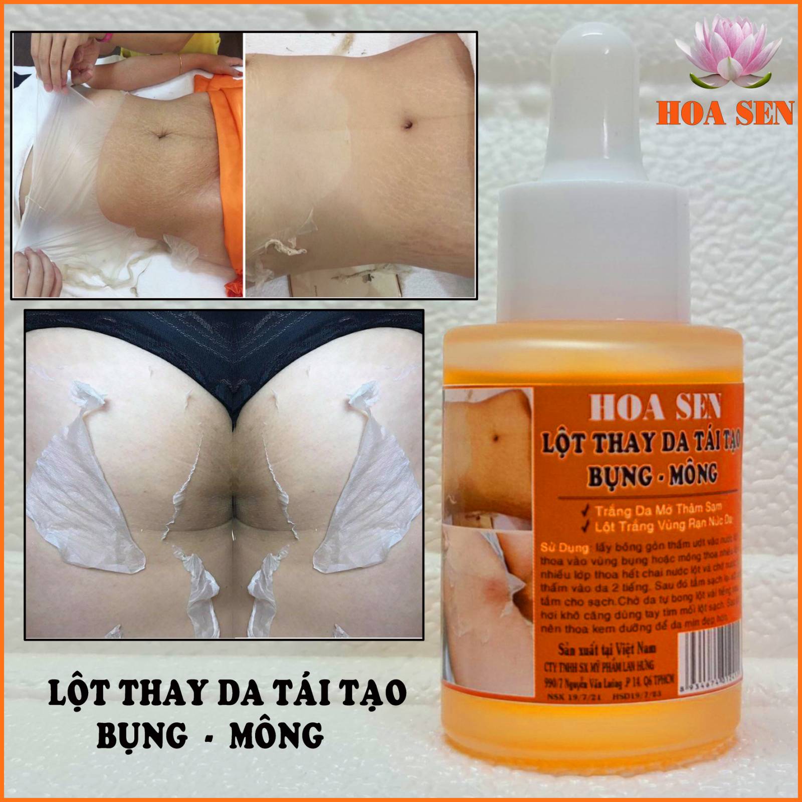 Lột Thay Da Mông Bụng Hết Thâm Rạn Nứt Da Cao Cấp
