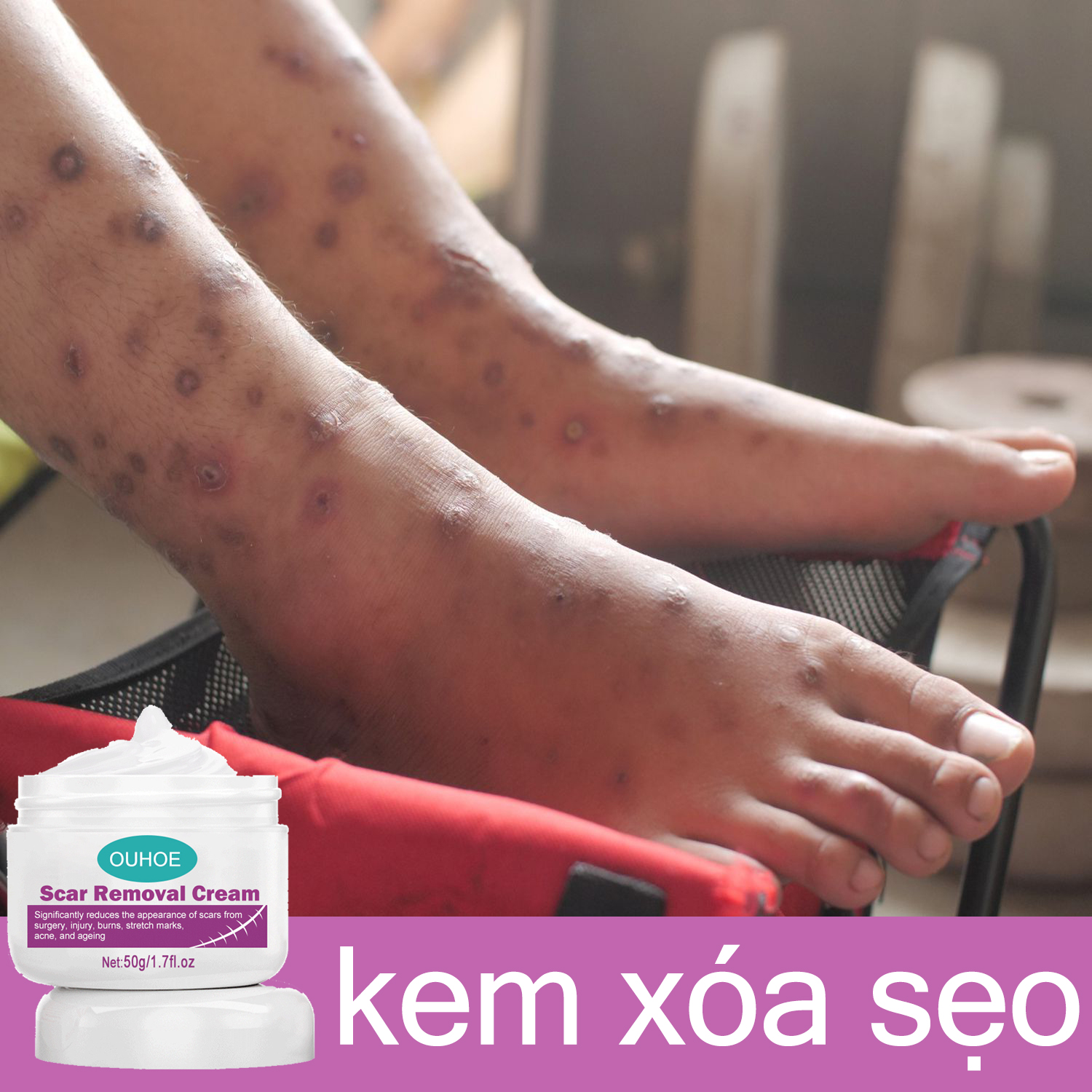 Kem sẹo kem xóa mờ sẹo kem loại bỏ sẹo đen loại bỏ vết thương cũ muỗi cắn sẹo sẹo lồi bỏng da đầu