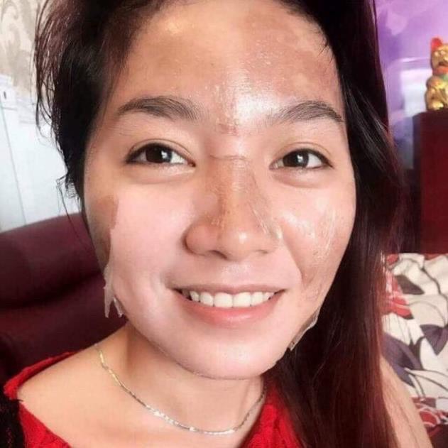 Peel da TCA 50% Đặc Trị Sẹo Rỗ, đánh bay Mụn, Hết thâm, nám, lỗ chân lông to, da dầu, rạn, sẹo lồi, Làm Hồng Ti, Hết Thâm Bẹn Nách, làm trắng mịn da