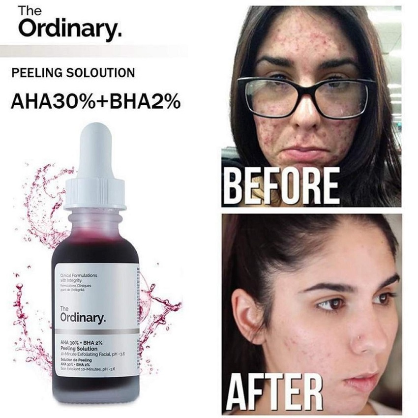 Tinh chất serum the ordinary aha 30% + bha 2% peeling solution