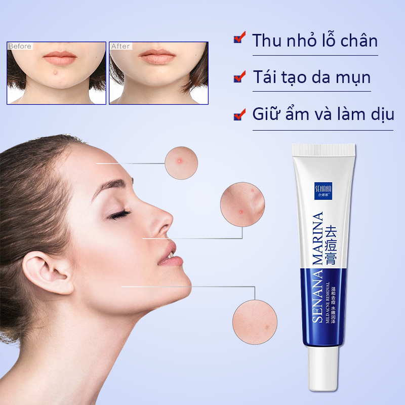 Kem giảm mụn SENANA Kem loại bỏ mụn Kem Hết Mụn Chiết Xuất Nha Đam làm mờ các vết thâm sẹo kiểm soát dầu dưỡng ẩm 30g