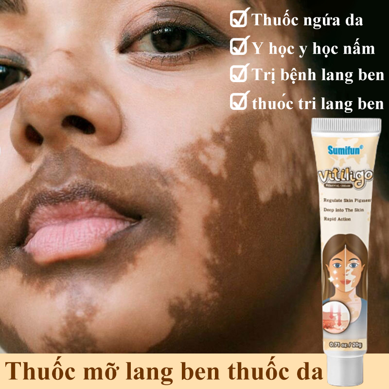 Thuốc mỡ lang ben thuốc da 20g Thuốc ngứa da Y học y học nấm Kem mỡ lang ben và chứng bạch tạng Trị bệnh lang ben thuốc trị lang ben