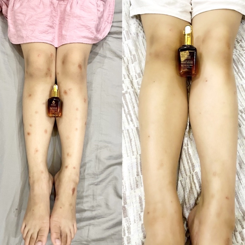 Tinh chất Xóa thâm Minh Khang chính hãng , Xoá mờ thâm sẹo,thâm mắt, thâm môi,thâm nách,thâm mụn