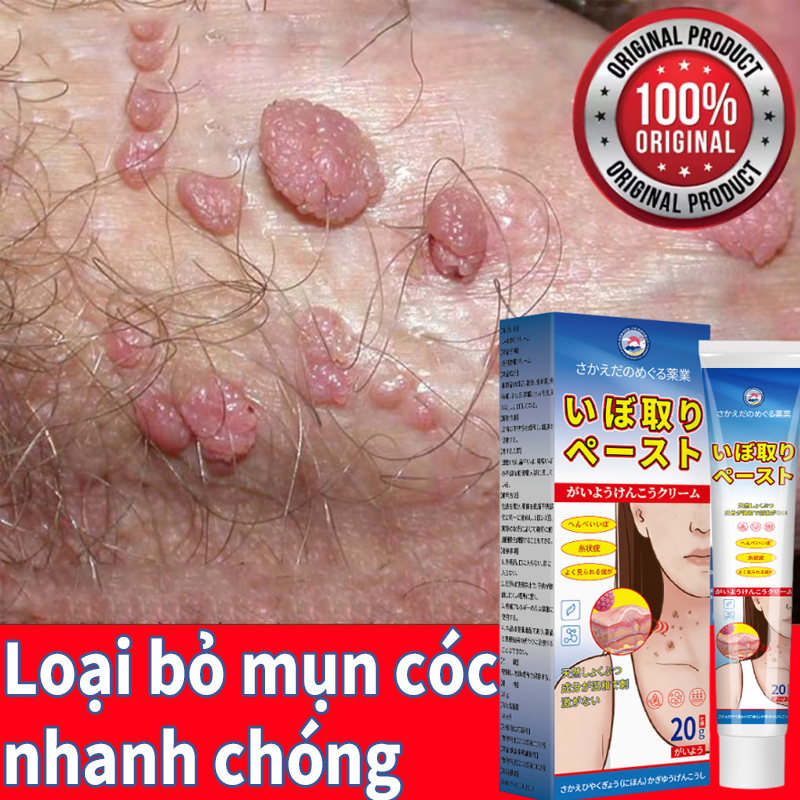 kem trị mụn cóc mụn thịt kem tẩy nốt ruồi mụn thịt Kem  tẩy nốt ruồi mụn thịt mục cóc an toàn hiệu quả nhanh chóng tẩy  lấy lại làn da tự tin căng đẹp