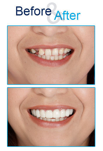 Răng giả Snap on smile