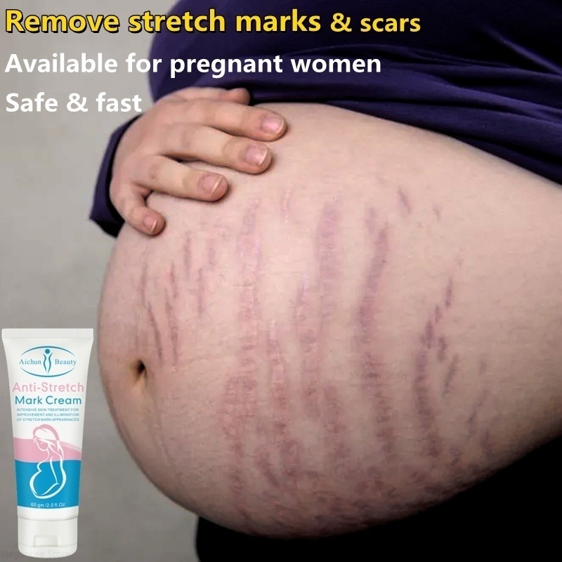 Chống rạn da Cream Removal Cream Removal Stretch Scar Removal Cream Phẫu thuật cắt bỏ vết sẹo rạn da 祛妊娠纹霜