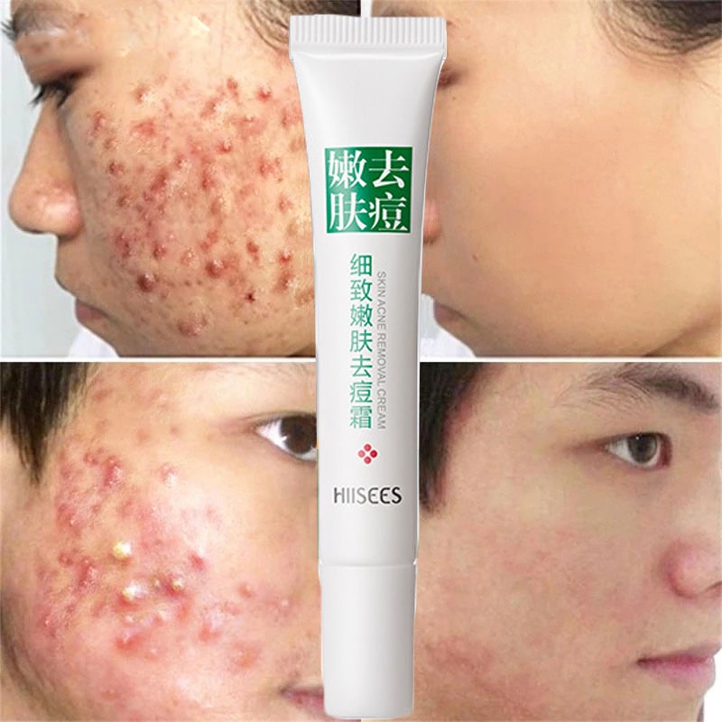 【CW】 Effective Acne Removal Treatment Herbal Anti-acne Repair Fade Spots Oil Control Whitening Moisturizing Face Gel